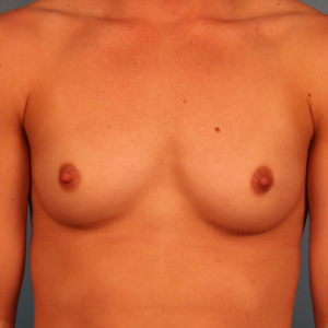 Before breast augmentation patient of Dr. Budny in Montgomery, Alabama. Pre-operative front-view image showing the patient's natural breast size, shape, and symmetry before breast implant surgery.