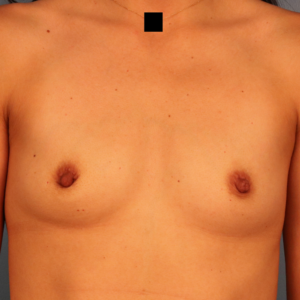 Before breast augmentation by Dr. Budny in Montgomery, Alabama. Pre-operative front-view photo showing the patient's natural breast contour and volume before cosmetic breast implant surgery.