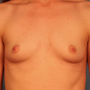Before breast augmentation patient of Dr. Budny in Montgomery, Alabama. Front-view pre-operative image showing the patient's natural breast size and contour before breast enhancement surgery.