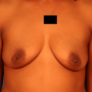 Before breast augmentation by Dr. Budny in Montgomery, Alabama. Front-view pre-operative photo showing the patient's natural breast volume, shape, and proportions before cosmetic breast implant surgery.
