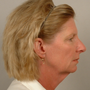 Right side view before facelift, endoscopic brow lift, and upper and lower blepharoplasty by Dr. Bentley in Montgomery, AL.