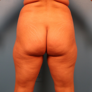 Preoperative view of a female patient before hip and thigh liposuction showing excess fat deposits in the hips, inner thighs, and outer thighs at a plastic surgery practice in Montgomery, Alabama.