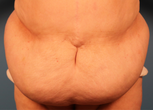 Before tummy tuck patient showing abdominal laxity and excess skin before surgery by Dr. Bentley in Montgomery, AL.