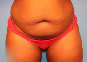 Before tummy tuck and liposuction patient showing excess abdominal skin and stubborn fat before body contouring surgery by Dr. Bentley in Montgomery, AL.