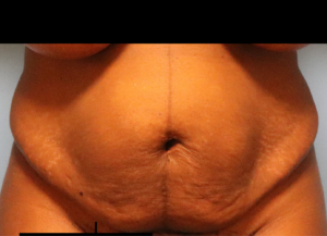 Before tummy tuck with liposuction patient showing abdominal fullness and loose skin before body contouring surgery by Dr. Bentley in Montgomery, AL.