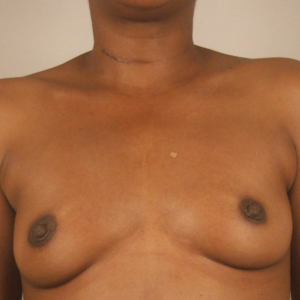 Front view before breast augmentation surgery by Dr. Bentley in Montgomery, AL.