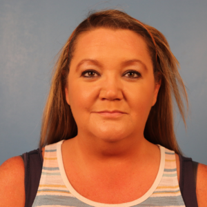 Frontal preoperative view of a patient before submental liposuction showing excess fullness beneath the chin and along the upper neck at a plastic surgery practice in Montgomery, Alabama.
