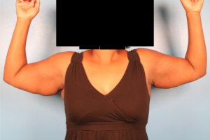 Front view before arm lift surgery (brachioplasty) by Dr. Bentley in Montgomery, AL.