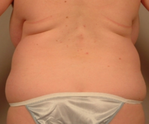 Back view before liposuction of the flanks and sacroiliac crest by Dr. Bentley in Montgomery, AL.