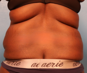 Back view before liposuction of the flanks, sacroiliac crest, and bra strap area by Dr. Bentley in Montgomery, AL.
