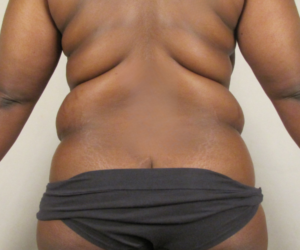 Back view before flank, sacroiliac crest, and bra strap liposuction by Dr. Bentley in Montgomery, AL.