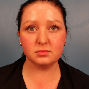 Front view before neck contouring surgery by Dr. Bentley in Montgomery, AL.