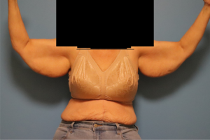 Front view before brachioplasty (arm lift) by Dr. Bentley in Montgomery, AL.