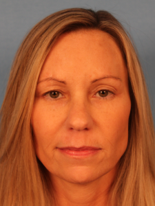 Before photo of a female patient prior to upper blepharoplasty by Dr. Robertson in Montgomery, Alabama, showing excess upper eyelid skin causing a heavy, hooded appearance.
