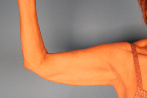 Case--20338 | Before Arm Lift (Brachioplasty) 1