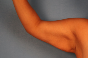 Case--58570 | Before Arm Lift (Brachioplasty) 1