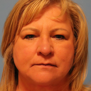 Preoperative frontal view of a patient before upper blepharoplasty showing excess upper eyelid skin and hooding at a plastic surgery practice in Montgomery, Alabama.