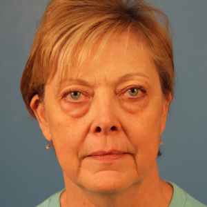Preoperative frontal view of a patient before upper blepharoplasty and transconjunctival lower blepharoplasty showing excess upper eyelid skin, eyelid hooding, and under-eye fullness at a plastic surgery practice in Montgomery, Alabama.