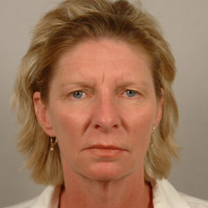 Case--23710 | Before Face 1