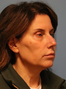 Case--64264 | Before Face 2