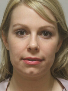 Case--36360 | Before Face 1