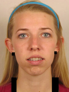 Case--40340 | Before Face 1