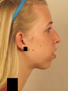Case--40340 | Before Face 2