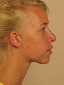 Case--40340 | After Face 2