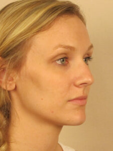Case--48417 | Before Face 2