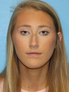 Case--51601 | Before Face 1