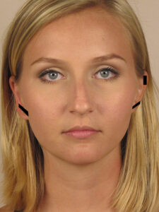 Case--51764 | Before Face 1
