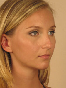 Case--51764 | Before Face 2