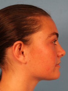 Case--65292 | After Face 2