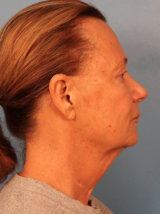 Case--52401 | Before Face 2