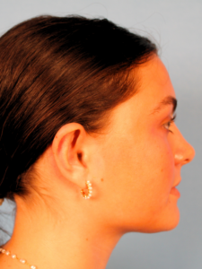 Case--65292 | Before Face 2