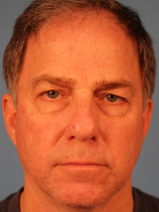 Case--63922 | Before Face 1