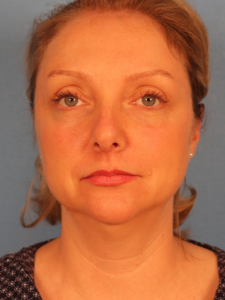 Case--54979 | Before Face 1