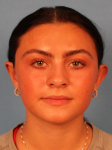 Case--65292 | Before Face 1